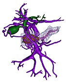 Pancreatic cancer, 3D CT scan