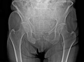 Hip fractures, X-ray