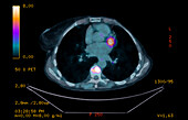 Metastatic breast cancer, PET scan