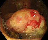 Cancer of the caecum, endoscope view