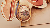 Testicular cancer, conceptual illustration