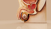 Testicular cancer, conceptual illustration