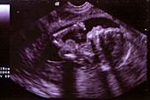 Ultraschallbild, Fötus 5. Monat