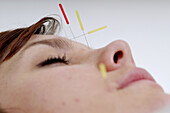 Acupuncture