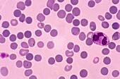 Red blood cells with spherocytosis