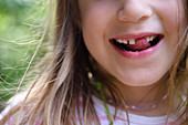 Girl with missing tooth