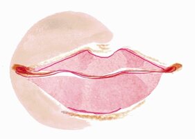 An illustration of of lips representing a cold sore